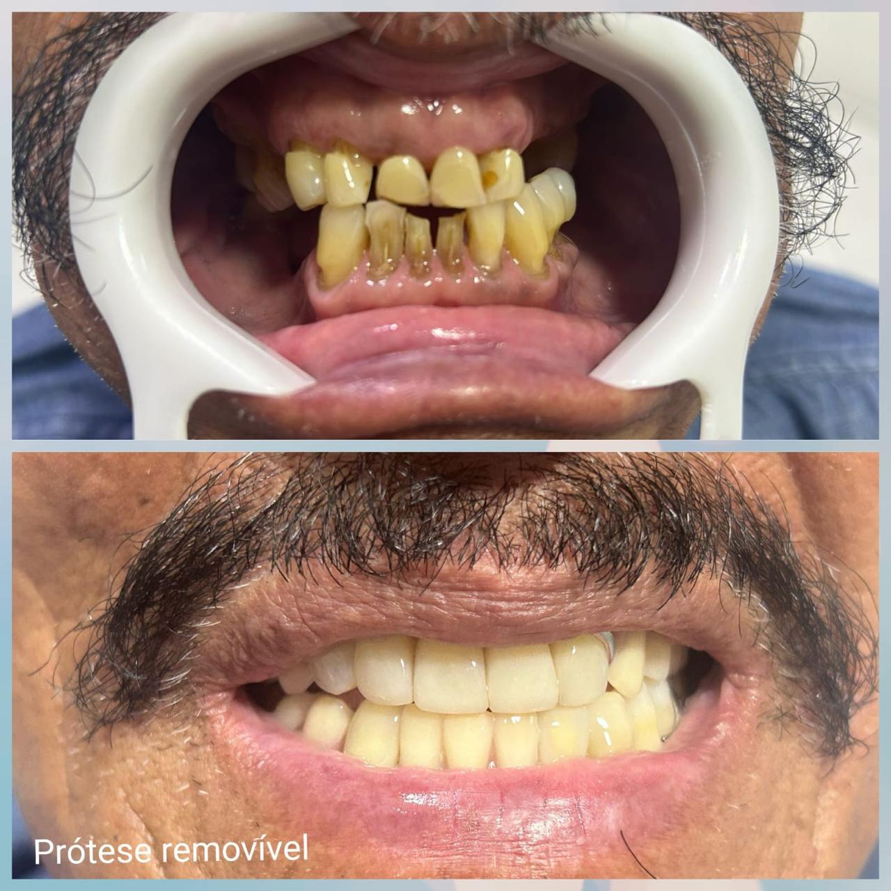 Resultado sorriso 1