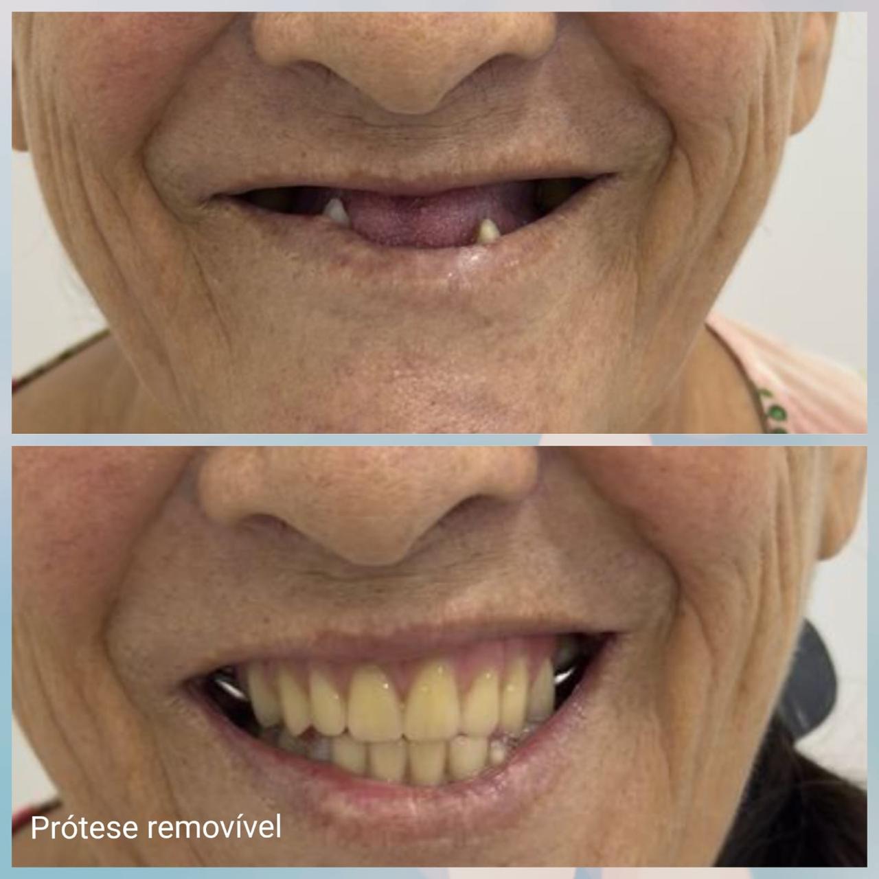 Resultado sorriso 3