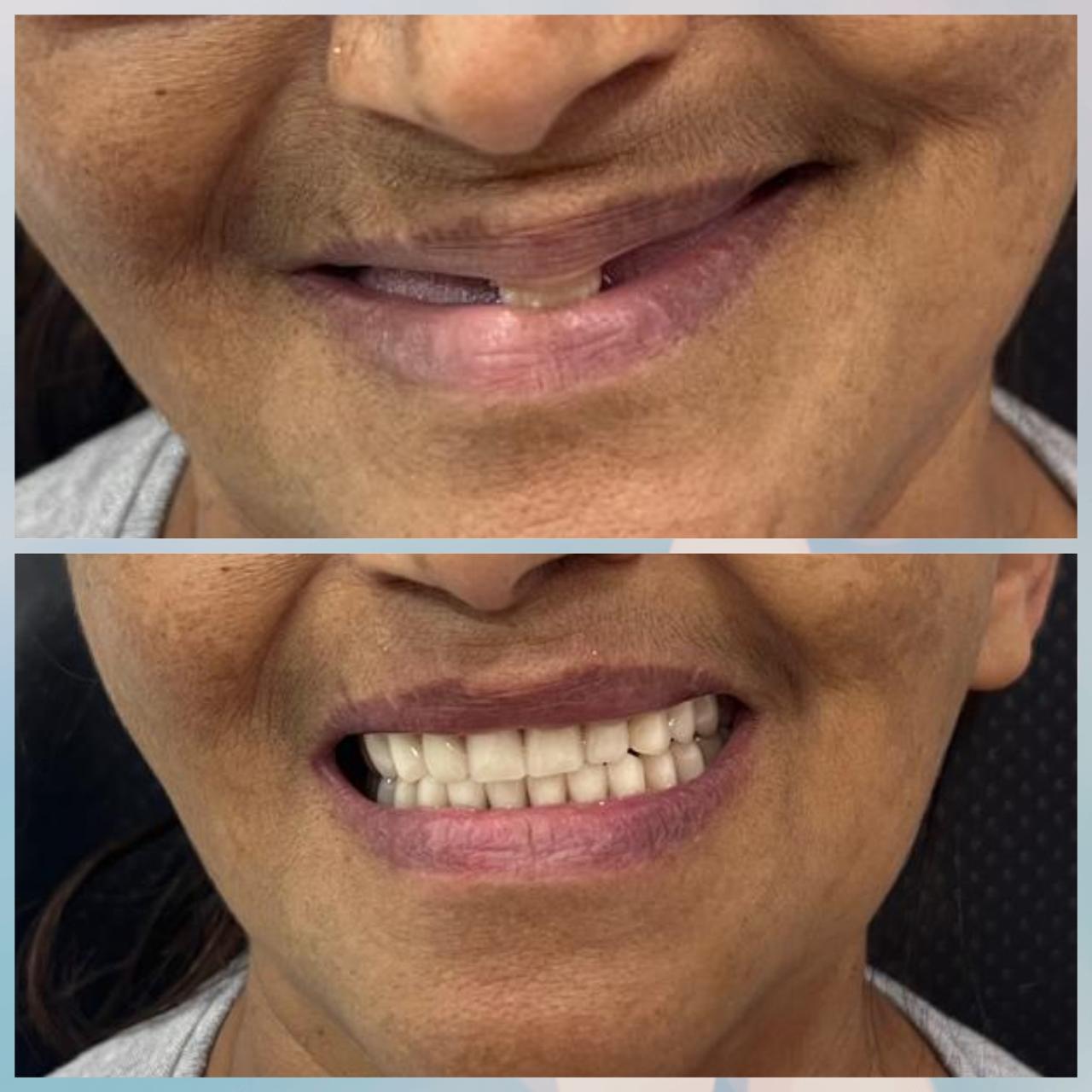 Resultado sorriso 4
