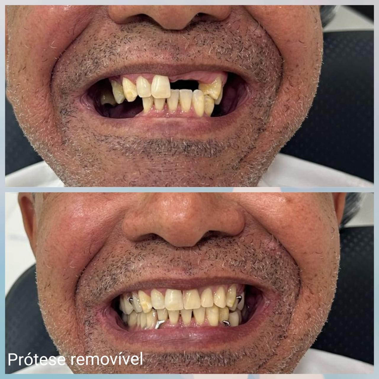 Resultado sorriso 5